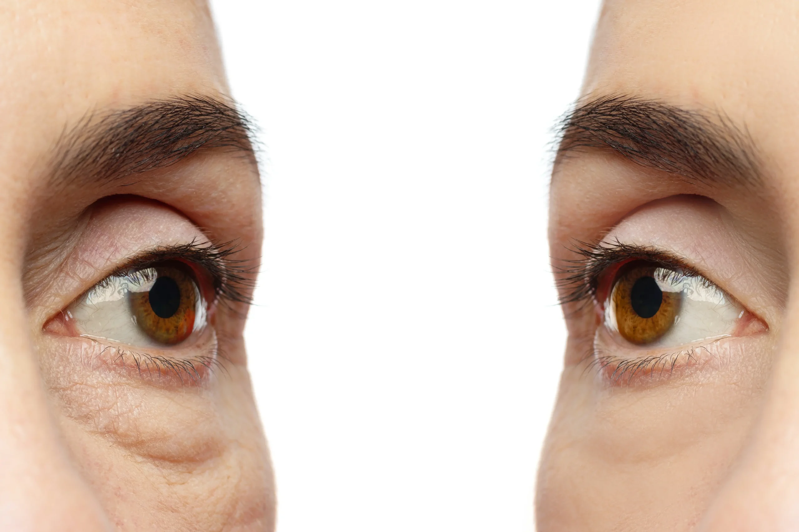 Tratamiento para las ojeras